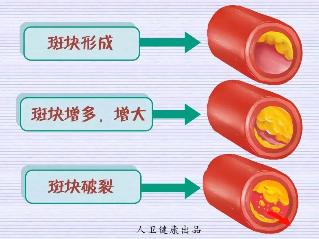 但如果血脂过高,可在血管内皮沉积,逐渐形成动脉粥样硬化斑块"斑块"