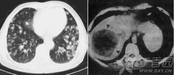 熟记这些 ct 表现,一眼识破转移性肺癌