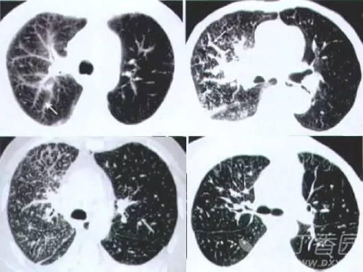 熟记这些 ct 表现,一眼识破转移性肺癌