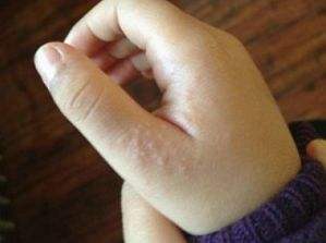 宝宝的手碰到脏东西湿疹了怎么办