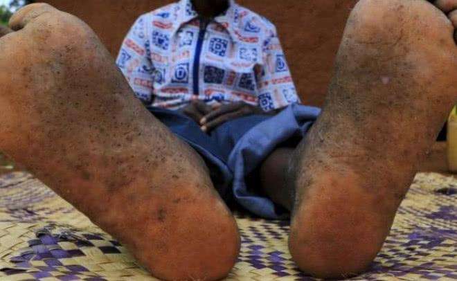 非洲人没有鞋子穿, 脚上千疮百孔, 中国给他们捐出三千万双鞋子!