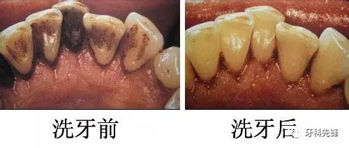 从没洗过牙的你,牙齿就是这么掉的!是时候放下对洗牙的偏见了!