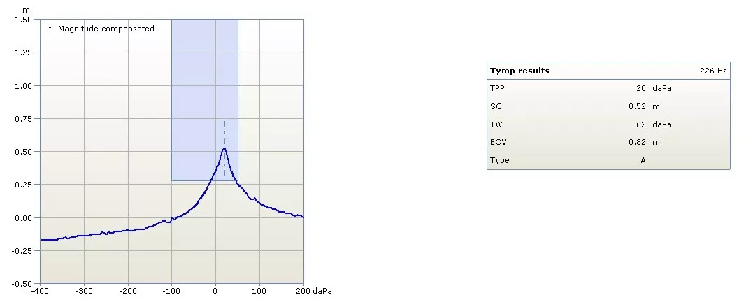 耳声发射(oae ,otoacoustic emission)——必查