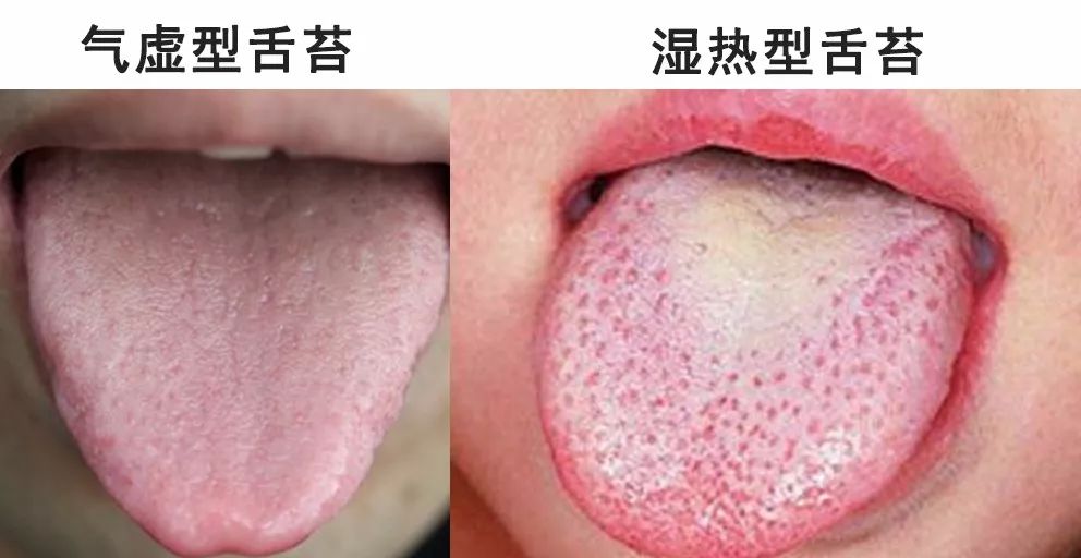 舌边红 这是湿热体质的特点 而气虚体质的舌头 主要特征是有齿印,舌苔