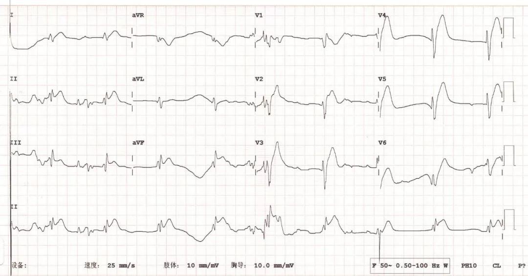 高手教你看心电图!