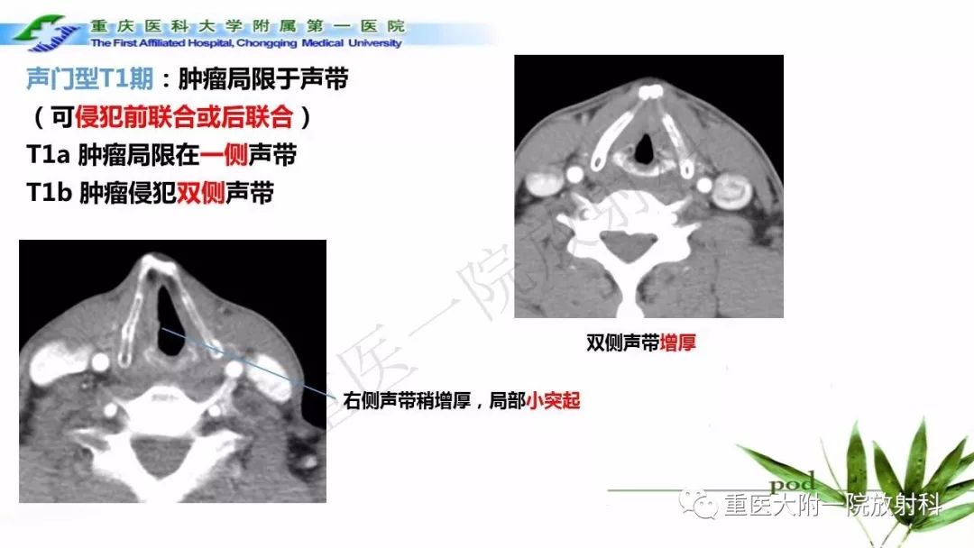 喉部解剖及t分期影像诊断