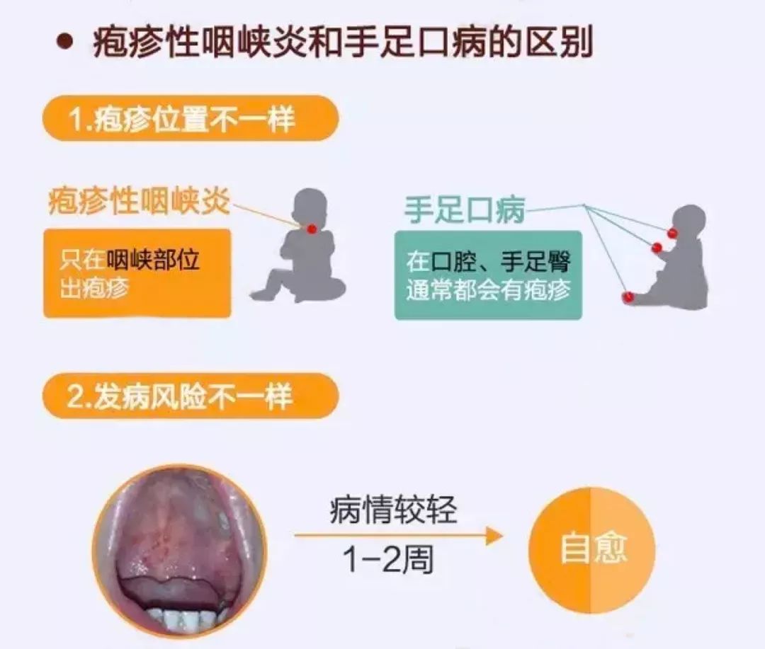 什么是疱疹性咽峡炎？如何预防小儿疱疹性咽颊炎 - 宝宝健康 - 宝妈育儿常识网