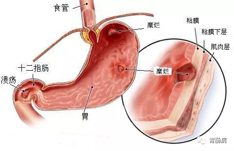 糜烂性胃炎吃什么药（糜烂性胃炎吃什么药能根除）