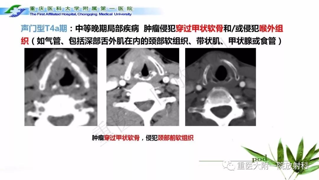 喉部解剖及t分期影像诊断