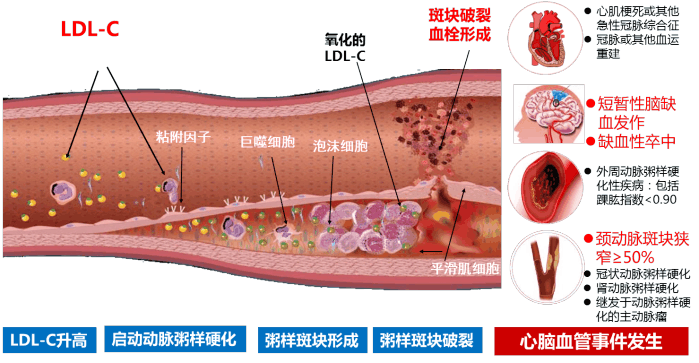 动脉粥样硬化: 越早治疗, 越多获益