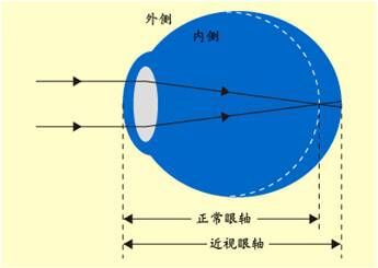 ok镜),三是早期近视使用药物干预(低浓度阿托品),四是做屈光手术