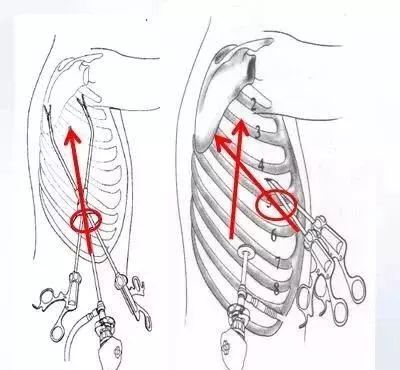 【"肺"常对话】认识单孔胸腔镜肺部手术