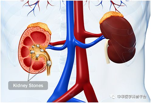 可引起肾区疼痛伴肋脊角(肋脊角为第12肋骨与脊柱构成的夹角)叩击痛