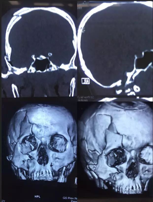 病例分享:神经科,眼科联合修复颅眶复杂骨折并视神经