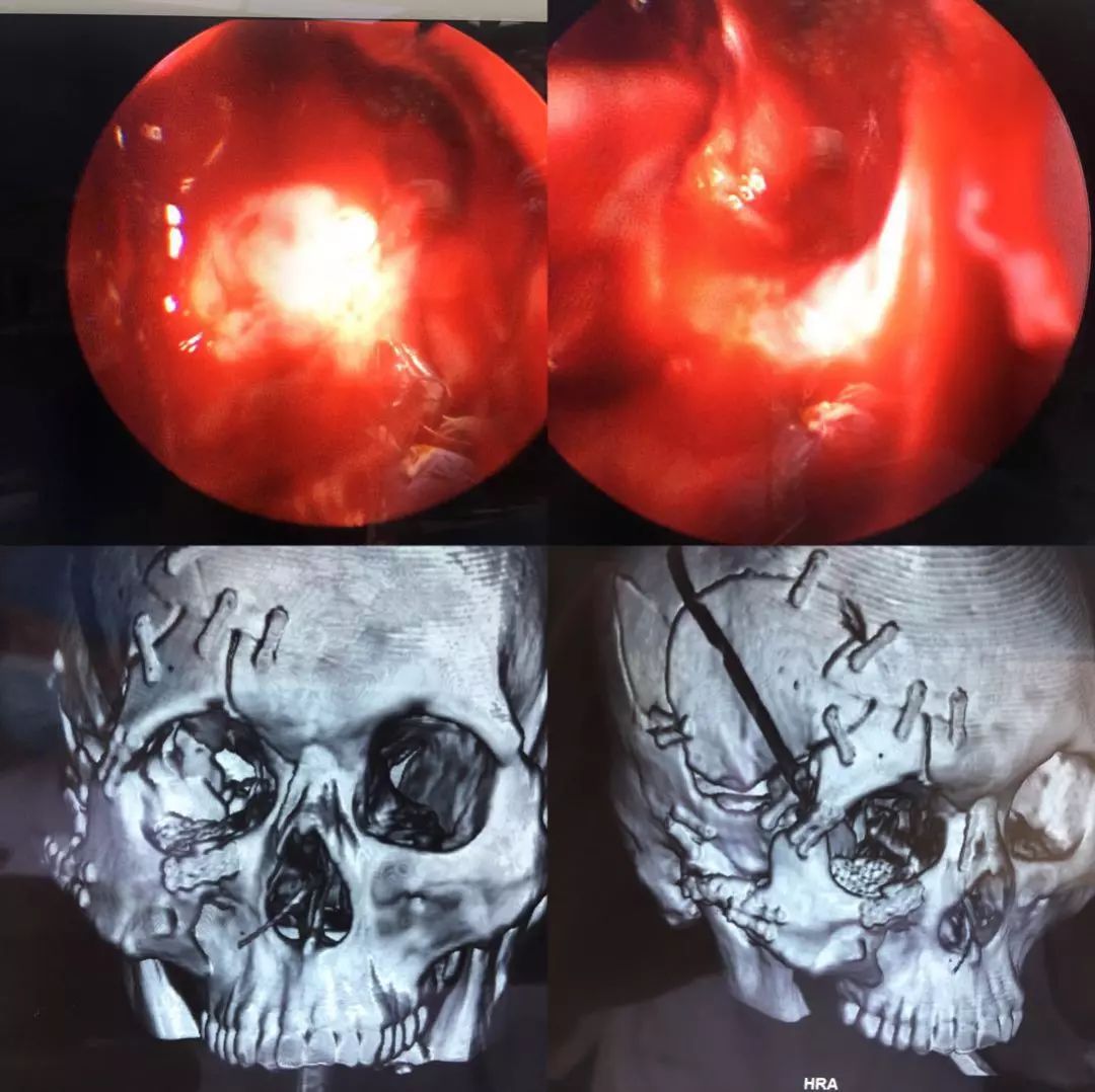 病例分享:神经科,眼科联合修复颅眶复杂骨折并视神经管减压术
