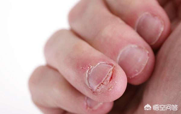 为什么人咬自己的指甲会上瘾?