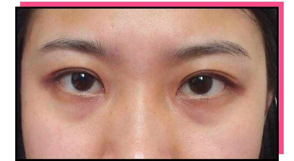 造成色素沉淀在眼周 一般是各种外部诱因导致 眼袋跟黑眼圈的区别 就