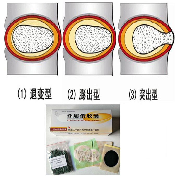 腰间盘压迫神经用脊痛消组合保守治!