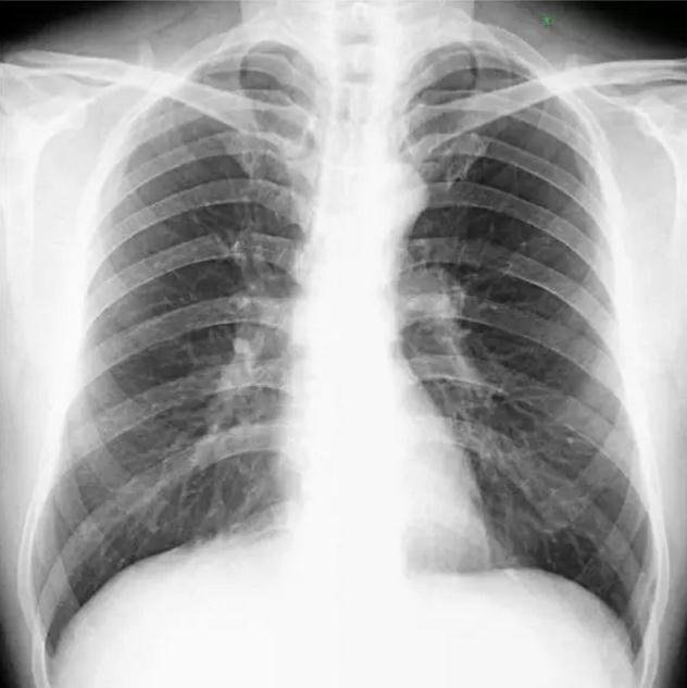 天地智慧—胸片上如何阅读肺纹理的改变_搜狐健康