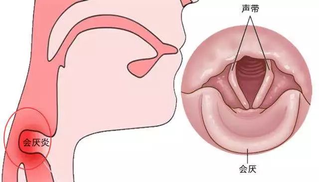 可能急性会厌炎