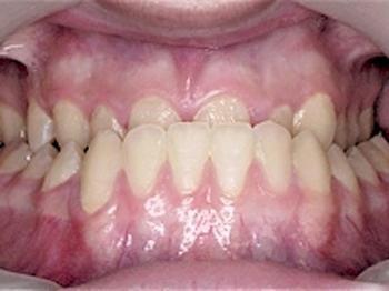 根据错牙颌畸形的不同类型,儿童牙齿的早期矫正主要有3个时间段可以