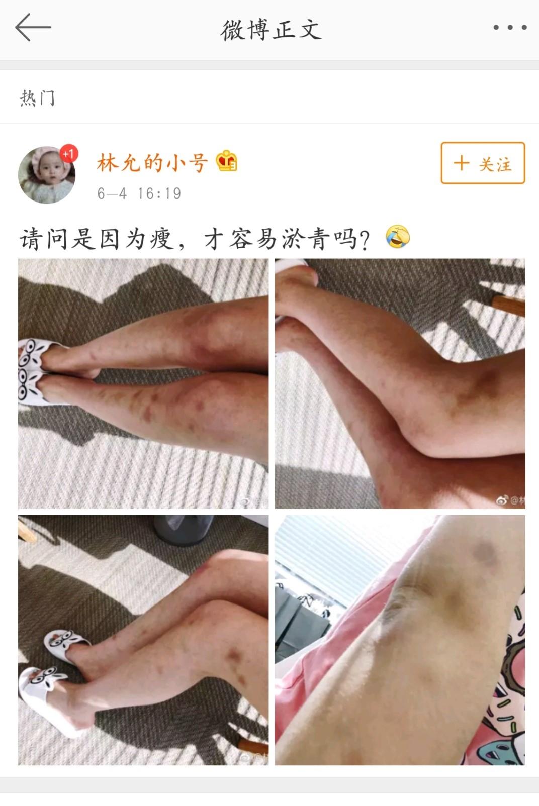 《美人鱼2》林允减肥过度致双腿淤青,颖儿减肥全靠"老干妈"?