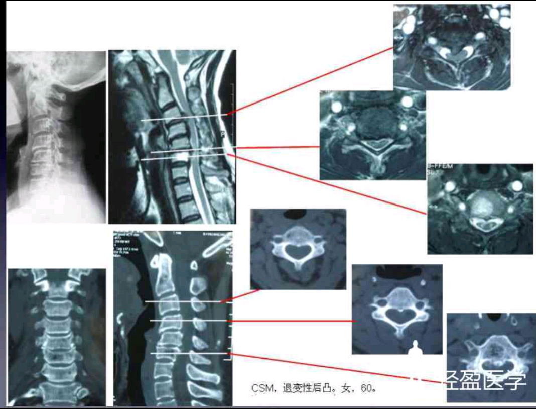 脊髓型颈椎病 颈椎后凸畸形 椎体血管瘤的术式一例