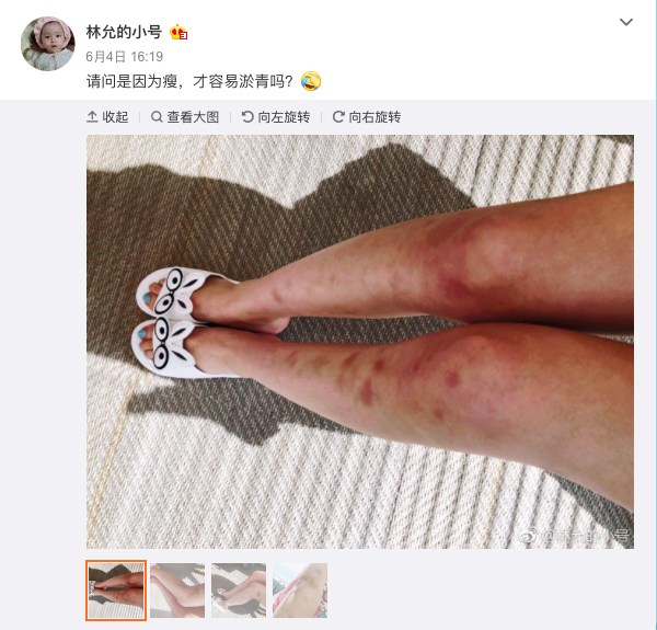 林允腿部出现神秘淤青,暴露了她成为最抢手星女郎的原因