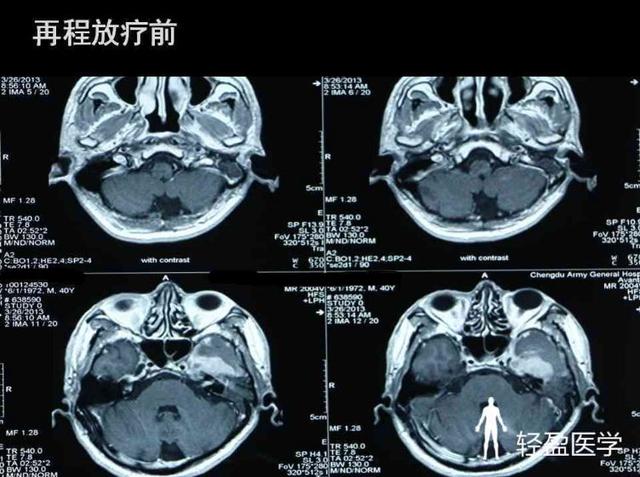 你离鼻咽癌还有多远来了解下鼻咽癌吧经典案例