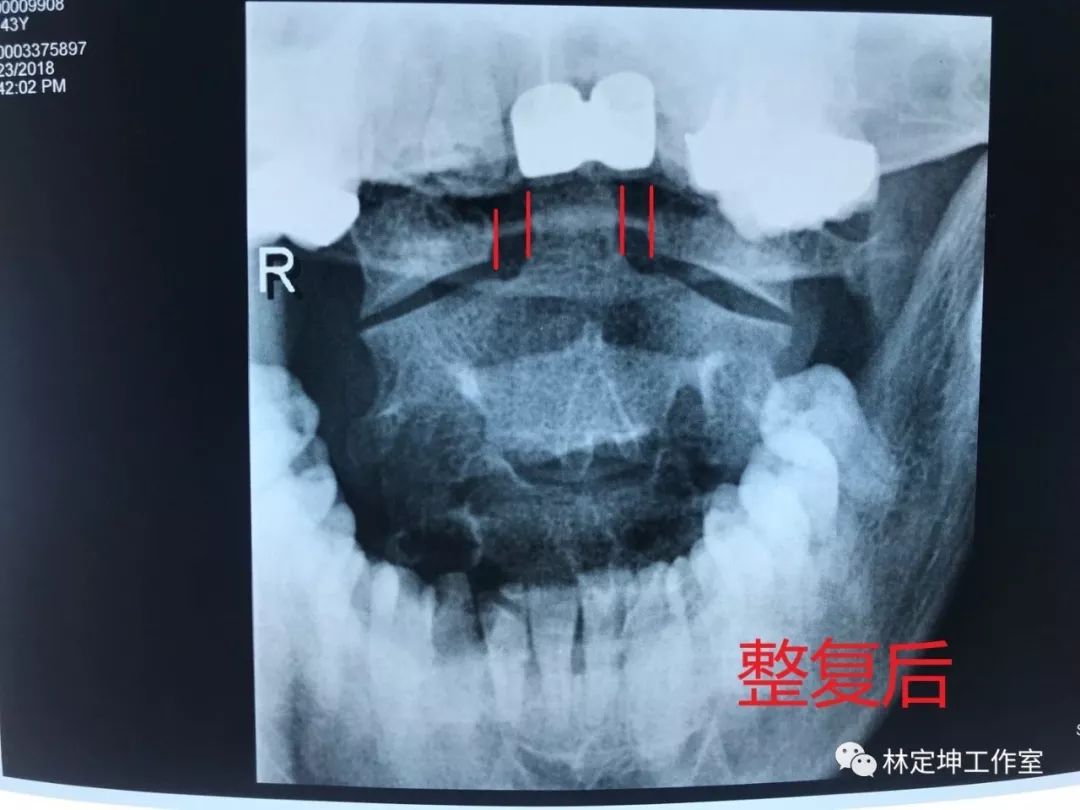 随后复查寰枢椎开口位照片,显示枢椎齿状突与寰椎侧块间隙基本等宽