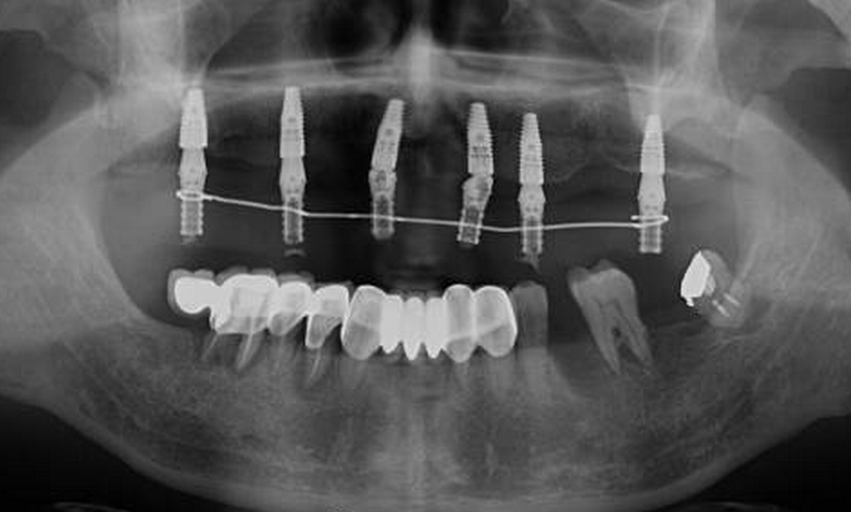 牙龈萎缩可以做种植牙么?