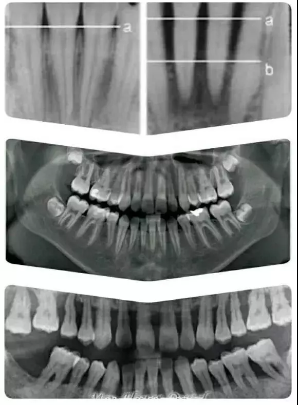 a 线萎缩到了b 线(中图为正常全口x光牙片,最下图为全口重度牙周病x光