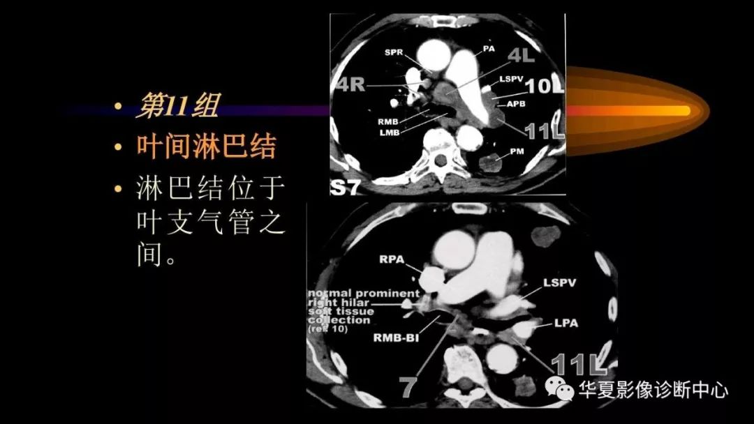 图文标注—ct上纵膈淋巴结分组,你都掌握了吗?