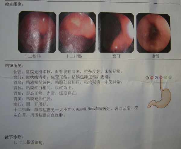 起效迅速,适用于胃及十二指肠溃疡,返流性食管炎或糜烂性食管炎等.