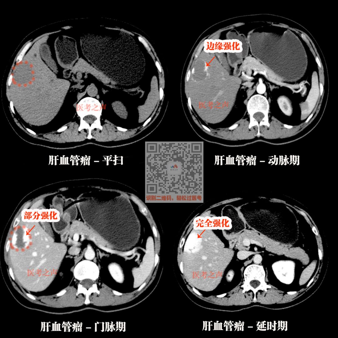 大部分是体检查出来的 ct特点: 黑色圆形影,边缘清晰,不被强化 肝囊肿