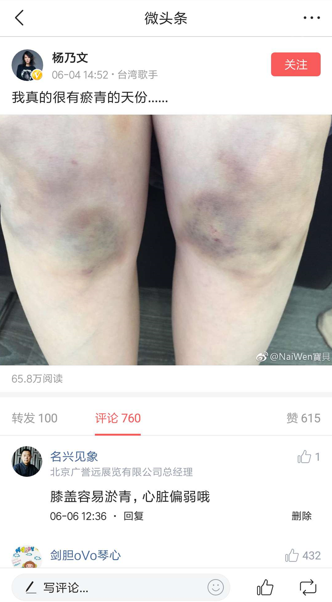 前两天在微头条看到杨乃文贴的膝盖淤青的照片,我当是还回复了"膝盖