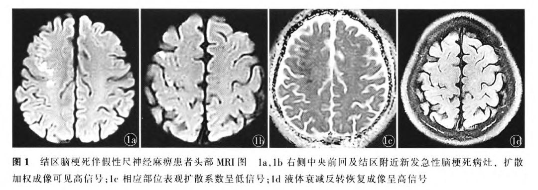 结区脑梗死致假性尺神经麻痹一例