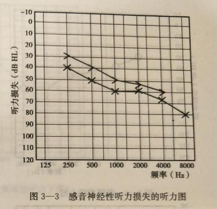 感音神经性听力下降:由于内耳经及神经破坏所致;多伴有高频听力损失