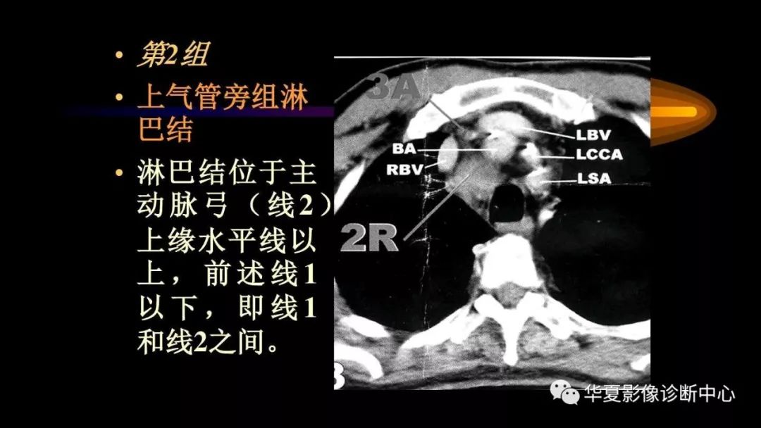 图文标注—ct上纵膈淋巴结分组,你都掌握了吗?