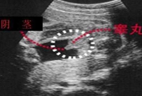 原来男宝宝的b超是这样的四维彩超单上的暗示准妈妈你知道吗