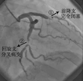 送入冠状动脉开口处,注射在x光下能显影的造影剂后,直观地看到血管病