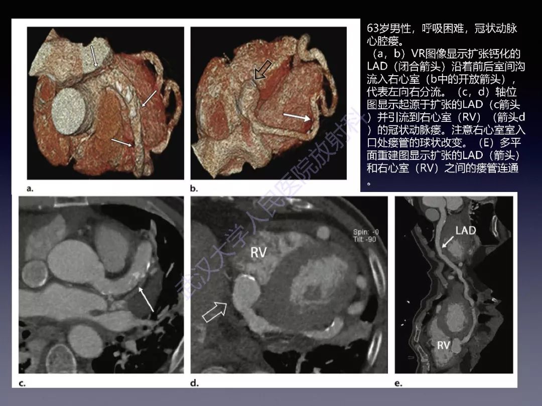 冠状动脉瘘:病理生理,影像表现及治疗