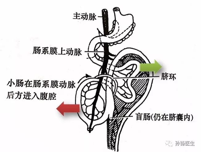 在肠袢由脐腔退回腹腔时,发生了原肠的第二次生理性旋转:头支在先,尾