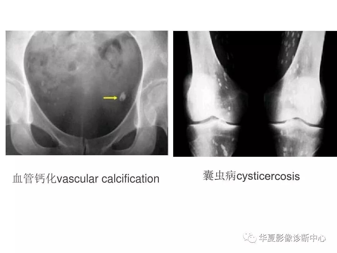 肿瘤样钙质沉着症影像诊断及鉴别诊断