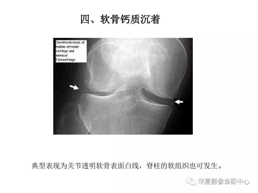 肿瘤样钙质沉着症影像诊断及鉴别诊断