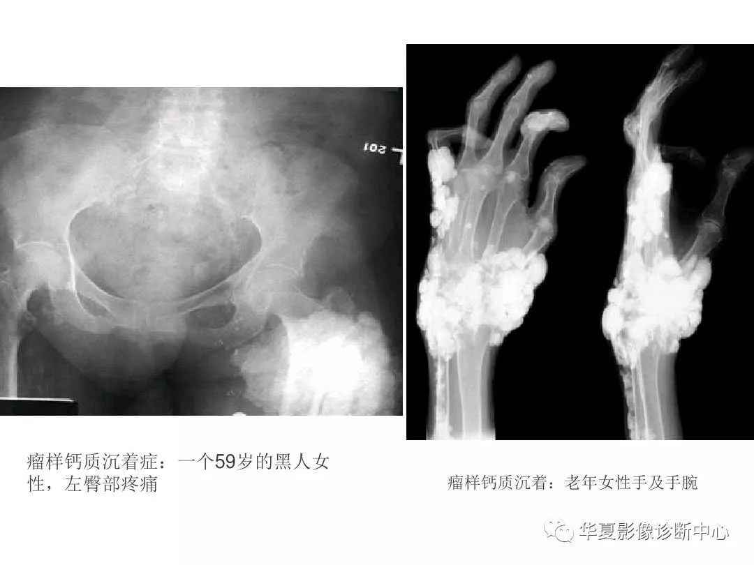 肿瘤样钙质沉着症影像诊断及鉴别诊断