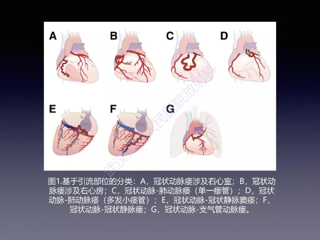 冠状动脉瘘:病理生理,影像表现及治疗