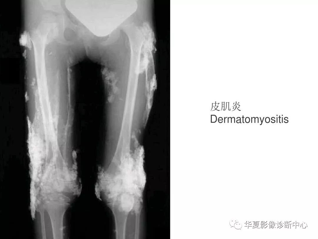 肿瘤样钙质沉着症影像诊断及鉴别诊断