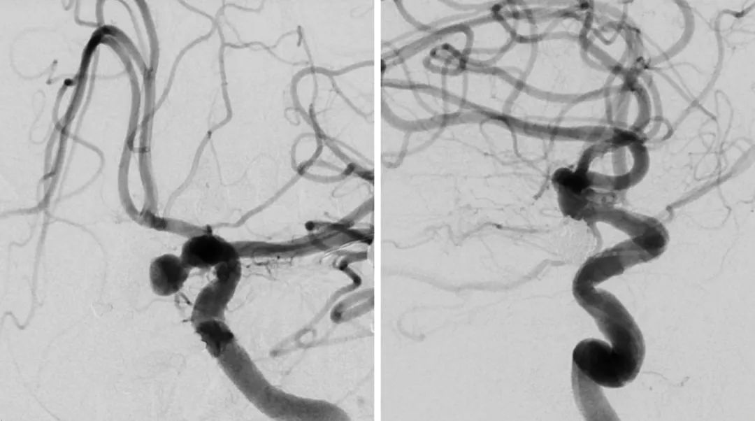 前循环动脉瘤:夹闭或栓塞? | the neurosurgical atlas全文翻译