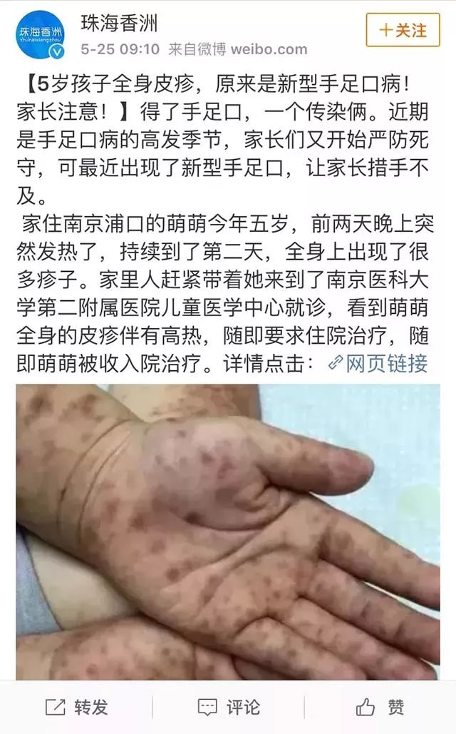 病因:疱疹性咽峡炎由肠道病毒引起,病原体为柯萨奇a组病毒.